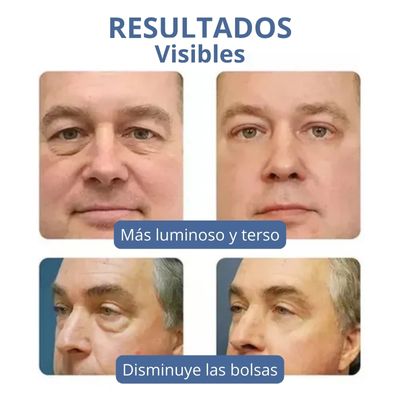OPENEYES® | Elimina ojeras y bolsas rápida y eficazmente
